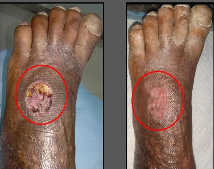 Diabetic-Cellulitis-and-Coverage-1.jpg