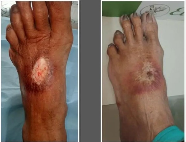 Diabetic-Cellulitis-and-fdytukl-1.jpg